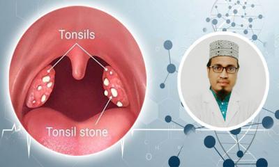 শীতকালে টনসিলের সমস্যা: প্রতিরোধের উপায়!